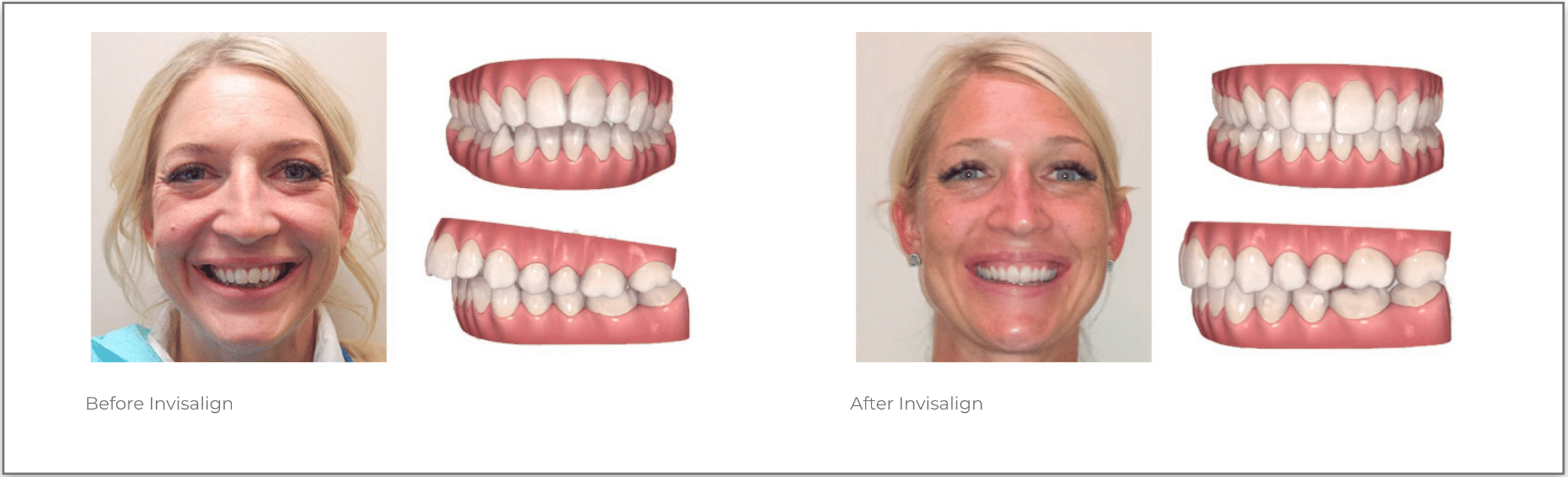 Invisalign; Invisible braces for the perfect smile. Finance Available